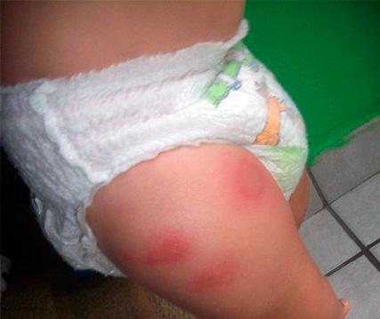 Білизняні клопи: фото комах і способи їх знищення