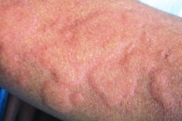 Укуси клопів   лікування, наслідки. Методи боротьби з клопами