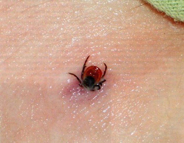 Укус кліща: як витягнути і що робити далі