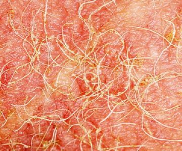 Як виглядають лобкові воші і звідки вони беруться