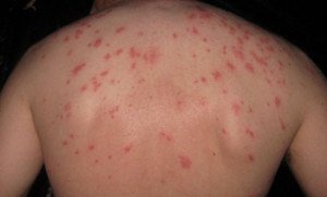 Укуси клопів — види укусів, симптоми [фото]