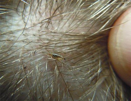 Вошей на голові: зовнішній вигляд, симптоми та шляхи зараження