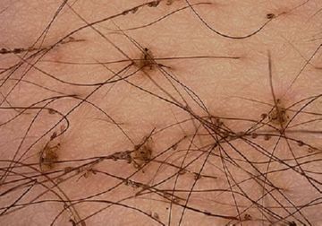 Як виглядають лобкові воші і звідки вони беруться