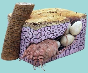 Коростяний кліщ у людини: перші симптоми зараження та лікування