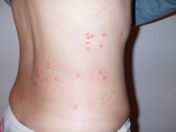 Укуси бліх: симптоми, лікування та профілактика