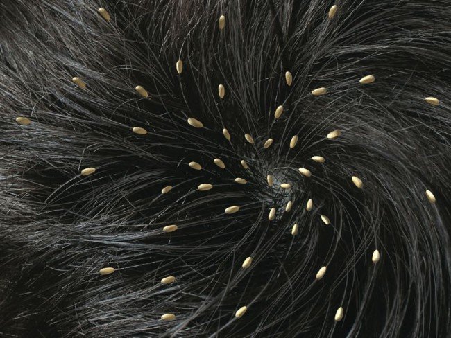 Оцет від вошей — ефективне лікування від паразитів