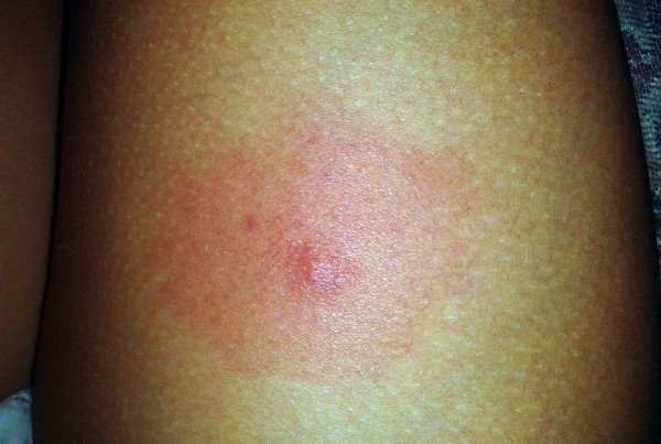 Укус комара: фото, зображення, картинки