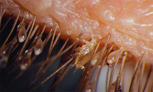 Лобкові воші – причини зараження та методи боротьби