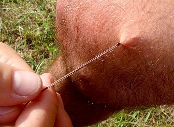 Які негативні наслідки для людини від укусу кліща? Зараження симптоми енцефаліту, хвороби Лайма