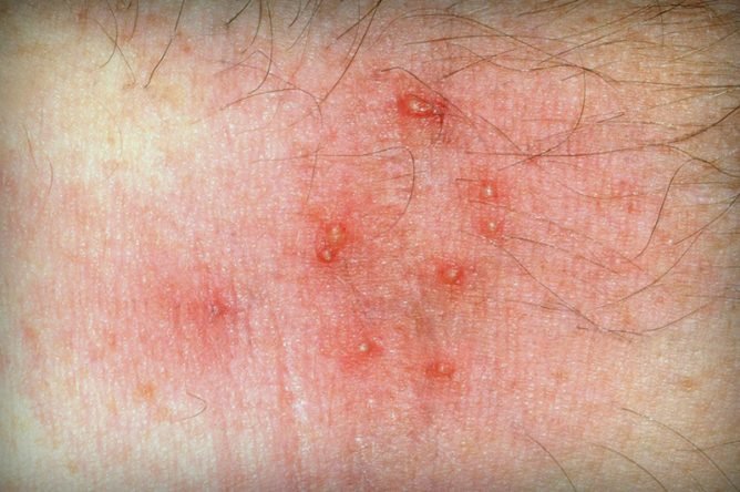 Лікування демодекозу на обличчі: як позбутися від особового кліща