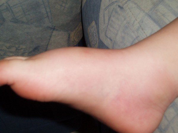 Укус оси: фото, зображення, картинки