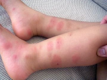 черты укуса клопа