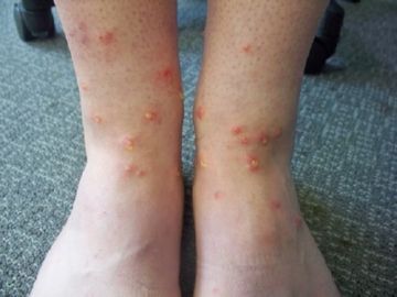 Пилові кліщі – наші сусіди