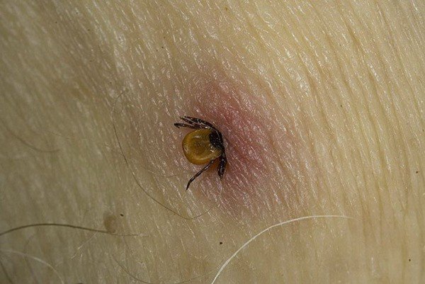 Укуси кліщів у людей і собак: фотографії, зображення