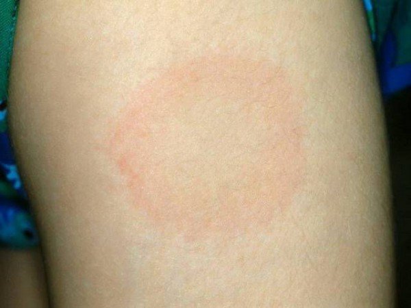 Укуси кліщів у людей і собак: фотографії, зображення