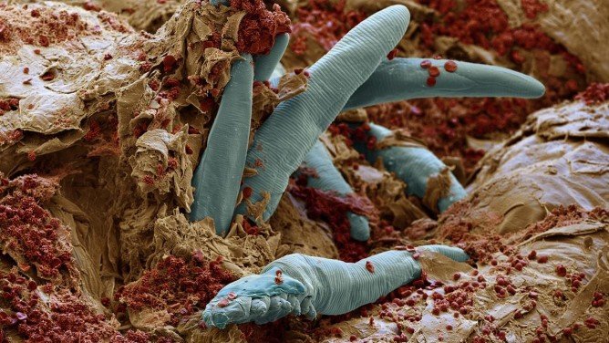 Підшкірний кліщ на обличчі: демодекс, волосяний і вугрової кліщ