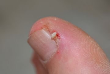 Піщана блоха   як не привезти хвороба з теплих країн