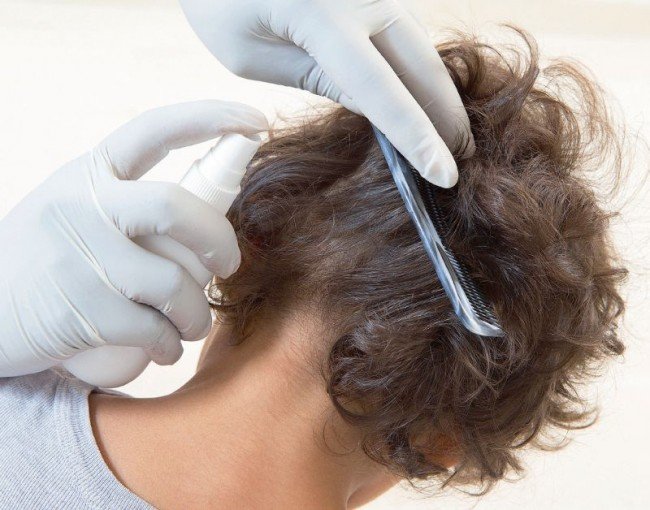 Вбити вшу: поради та рекомендації з ліквідації паразитів