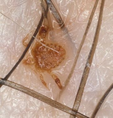 Як позбутися від лобкових вошей у чоловіків і жінок