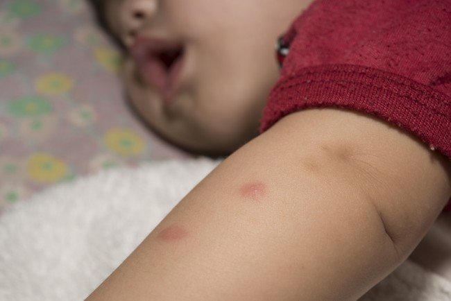 Як виглядає укус кліщів, змій, бліх та інших тварин: проінформований — значить обезопасен