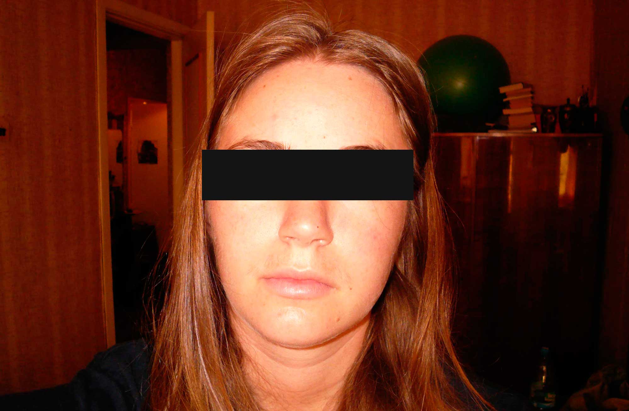 Як лікувати укуси постільних клопів у людини Як лікувати укуси постільних клопів у людини