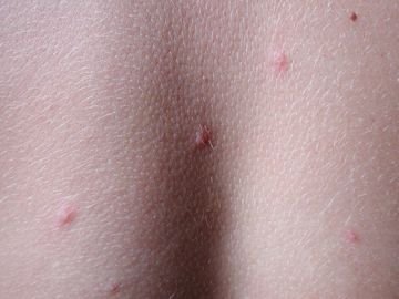 укус таракана