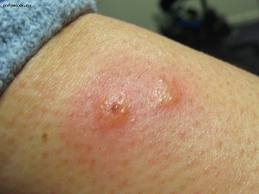 Блохи у людини Блохи у людини