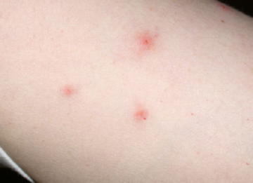 Як виглядають укуси різних видів вошей