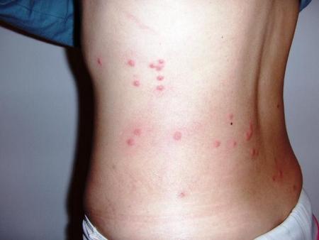 Білизняні клопи: фото комах і способи їх знищення