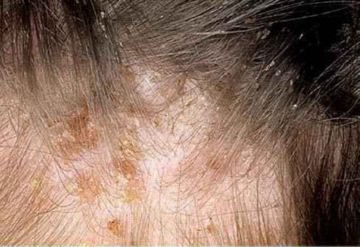 Як позбутися вошей швидко і легко з Пара Плюс