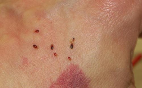 Блохи у людини – біологія комах і наслідки укусів