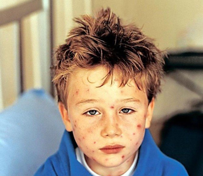 Кліщовий рикетсіоз або висипний тиф   симптоми і способи зараження