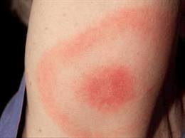 Як виглядають блохи