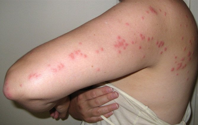 Звідки і чому зявляються домашні постільні клопи в квартирі