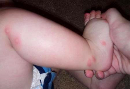 Укуси клопів – симптоми і можлива реакція організму