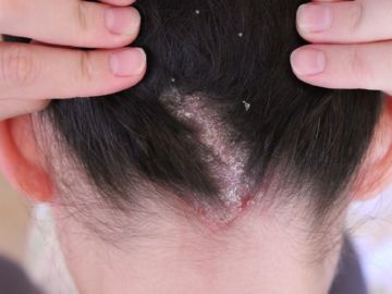 Як позбутися вошей швидко і легко з Пара Плюс Як позбутися вошей швидко і легко з Пара Плюс