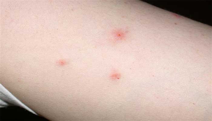 Кусають чи блохи людини і чому це відбувається