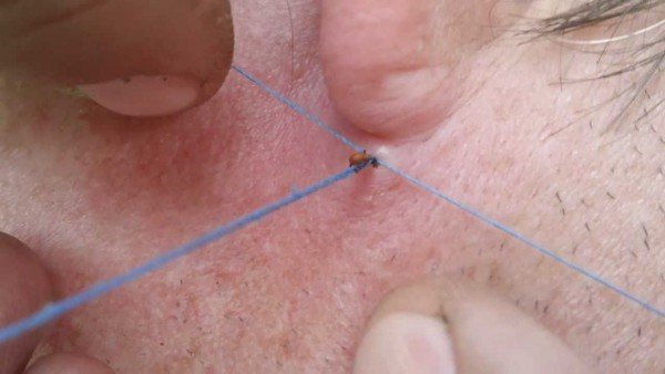 Шкірний кліщ псує обличчя, особливо жінок і вимагає серйозного лікування