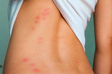 Укуси клопів: лікування, ускладнення і прояви