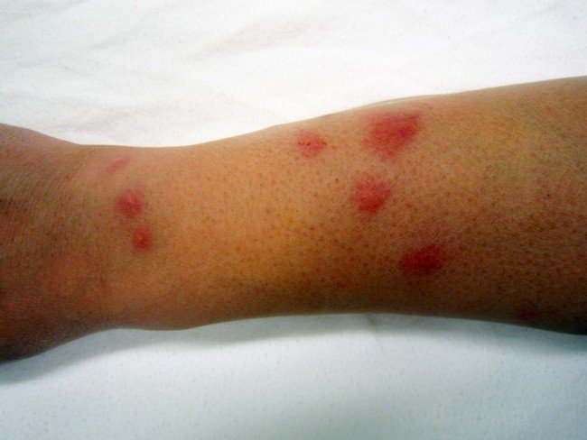 Домашні клопи: ефективна боротьба з шкідником — запорука міцного сну