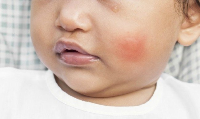 Як виглядає укус кліщів, змій, бліх та інших тварин: проінформований — значить обезопасен