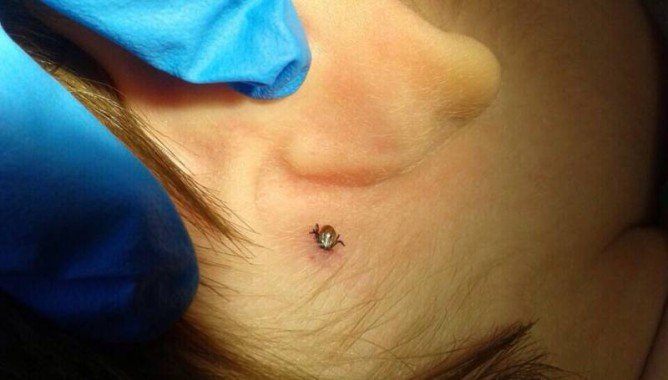 Тайговий кліщ і його небезпека для людини