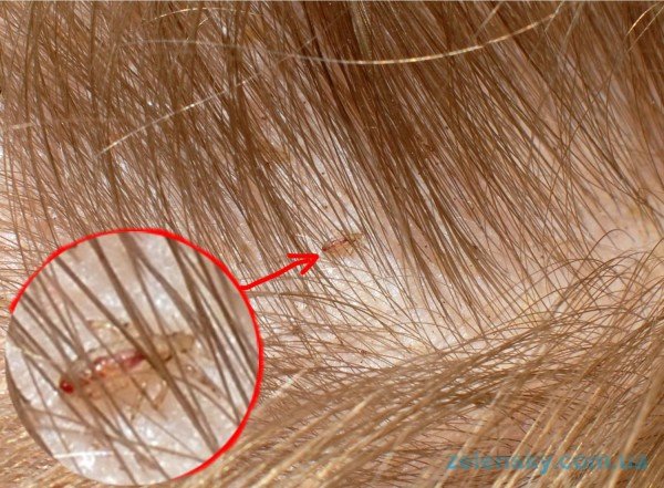 Воші: лікування педикульозу аптечними і народними засобами