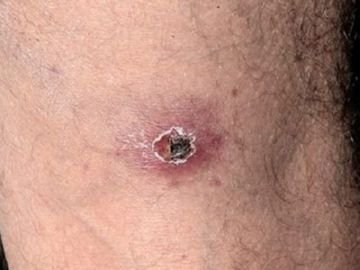 Кліщовий рикетсіоз: симптоми, лікування, профілактика