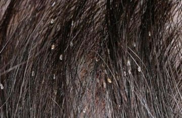 Гниди і довге волосся: вирішення проблеми і заходи профілактики