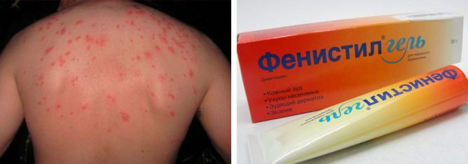 Мазь після укусів клопів: вибираємо найкраще, відгуки