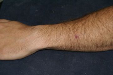 Аргасовые кліщі   як захистити себе і своїх тварин від паразитів