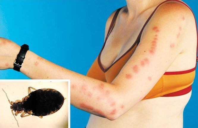 Які хвороби переносять клопи і чим вони небезпечні для людини