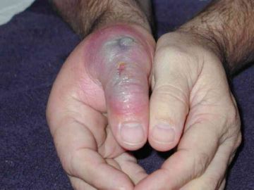 Павуки відлюдники – чим горозит укус одних з найбільш небезпечних членистоногих