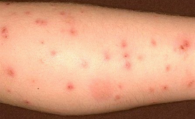 Укуси постільних клопів — Як виглядають і чим лікувати (фото)